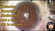 Cataract Surgery with Lysis of Posterior Synechiae and Pupil Restoration