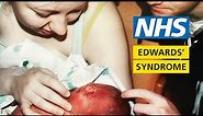 What it's like to have a baby with Edwards' syndrome - My Story - Chloe and Penelope | NHS