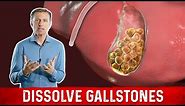 What Causes Gallstones & How to Treat Them – Dr.Berg