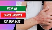 How to Identify an HIV Rash?