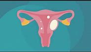Uterine Fibroids and Pregnancy
