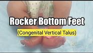 Congenital Vertical Talus