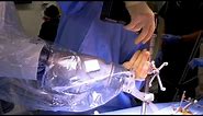 Robotic Spine Surgery Explained
