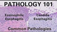 Eosinophilic Esophagitis & Candida Esophagitis | Pathology 101| GI Pathology