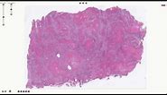 Histopathology - Squamous Cell Carcinoma of the Lung