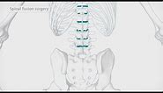 How back surgery (spinal fusion) is performed | Spire Healthcare