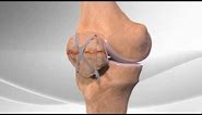 Patella Fracture Repair