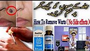 How To Remove Warts | Duofilm Wart remover | How to remove moles on face at home