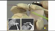 AO Lateral Clavicle—Dislocations and Fractures—The LCP Clavicle Hook Plate