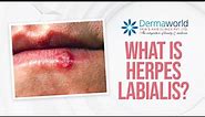 Herpes Labialis | Oral herpes | Cold Sores | Dr. Rohit Batra | Dermaworld Skin and Hair Clinics