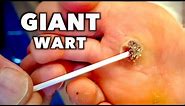 SCRAPING OFF A GIANT DEAD WART! | Dr Paul