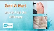 Corn Vs Wart - How Do I Tell The Difference