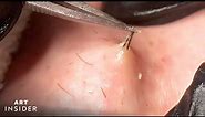 How Ingrown Hairs Are Removed | Art Insider