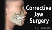 Corrective Jaw (Orthognathic) Surgery, Animation.