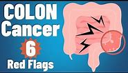 Colon cancer: 6 EARLY symptoms & why they occur | Colon cancer symptoms | colorectal cancer