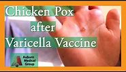 Chicken Pox after Varicella Vaccine | Auburn Medical Group