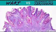 Wart vs Squamous Cell Carcinoma (Dermpath Pathology Dermatology Verruca Seborrheic Keratosis SCC)