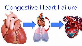 Congestive Heart Failure (CHF) Explained - MADE EASY