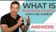 Keratosis Pilaris (KP) Explained | 208SkinDoc
