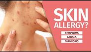What is Skin Allergy? Symptoms, Causes, Diagnosis and Triggers