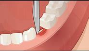 Dental Surgery Operation Root Canal, Implant, Anesthesia
