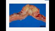 Histopathology Small intestine--Carcinoid tumor