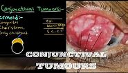 Conjunctival Tumours | Complete explanation with pictures