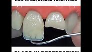 How to fix a chipped, cracked or broken tooth MyDentCart | Cracked tooth repair | Broken Tooth