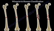 Fractures Of The Femur Shaft Winquist & Hansen - Everything You Need To Know - Dr. Nabil Ebraheim