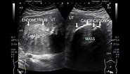 Ultrasound Video showing Two Fibroids, one is Calcified Fibroids.