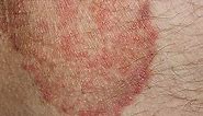 Itchy Skin Rash - Pictures, Causes, Symptoms, Treatment