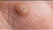 how to get rid of warts on fingers in a day