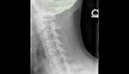 Cervical Spine Obliques Radiology Tutorial