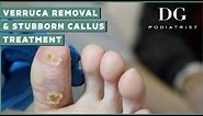 Verruca Mother Removal and Stubborn Callus Treatment | The Foot Scraper: DG Podiatrist