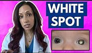White Spot In Your Baby's Eye? Eye Doctor Explains