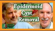 Epidermoid Cyst Removal INTACT| Auburn Medical Group