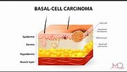 Basal Cell Carcinoma Causes, Warning Signs, and Treatments