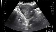 Ultrasound Video showing Fibroids with cervical Cysts.
