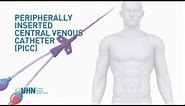 Learn About the Peripherally Inserted Central Venous Catheter (PICC)