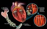 Heart Muscle Damage After Heart Attack Pictures