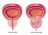 Pictures of Prostate Tumor Symptoms