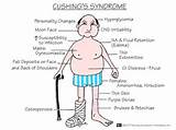 Cushings Symptoms Checklist Photos
