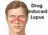 Pictures of Lupus Test Diagnosis