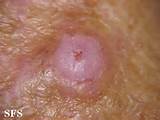 Images of Vulvar Cancer Types