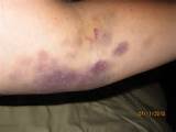 Photos of Symptoms Of Blood Clot