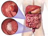 Bowel Cancer Vomiting Blood Pictures