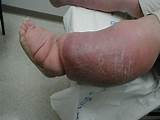 Pictures of Neuropathy In Feet And Swelling