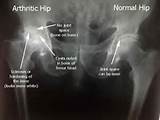 Pictures of Arthritis In The Hip