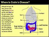 Pictures of Does Celiac Disease Cause Severe Abdominal Pain