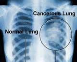 Chest X Ray For Cancer Screening